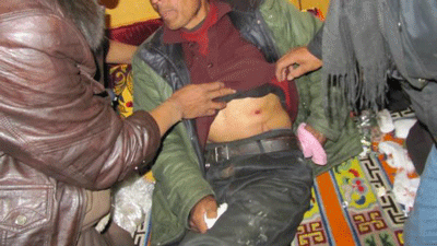 Tibetans show the gunshot wound of a protest victim in Draggo, Jan. 23, 2012.
